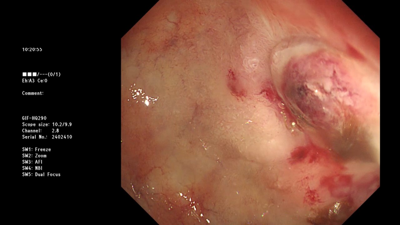 An endoscopically visible upper gastrointestinal bleeding ulcer.